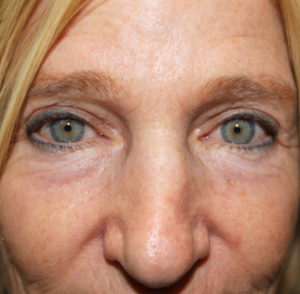 before & after blepharoplasty