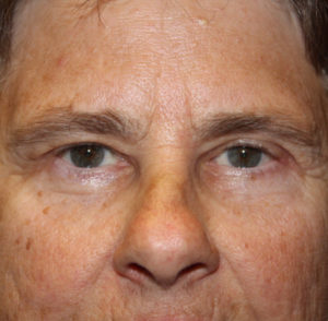 before & after blepharoplasty