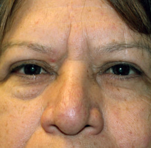 before & after blepharoplasty