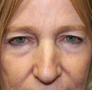 before & after blepharoplasty 