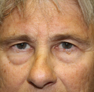 before & after blepharoplasty