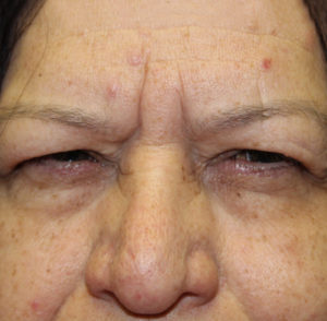 before & after blepharoplasty