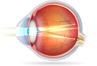 astigmatism graphic