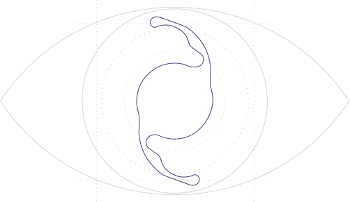 cataract ICL graphic